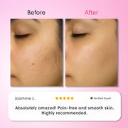 Hair Removal Trilogy Kit